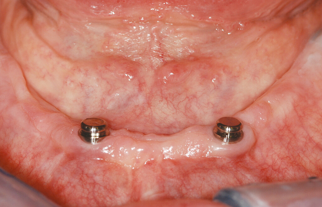 Clinical case with CM LOC®