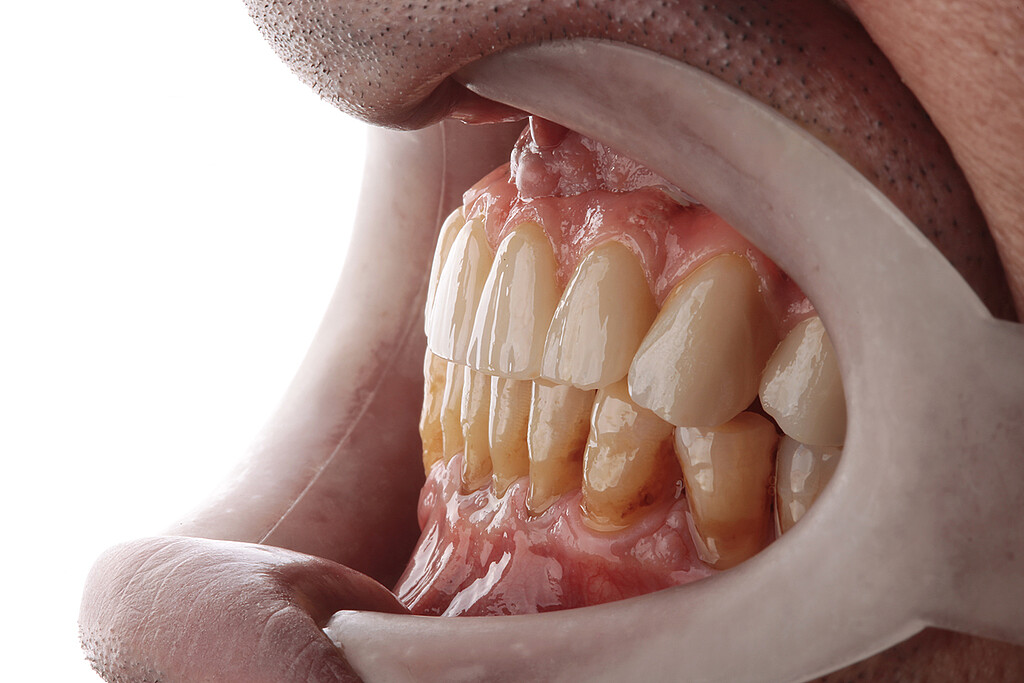 Clinical case with Pekkton® ivory. 