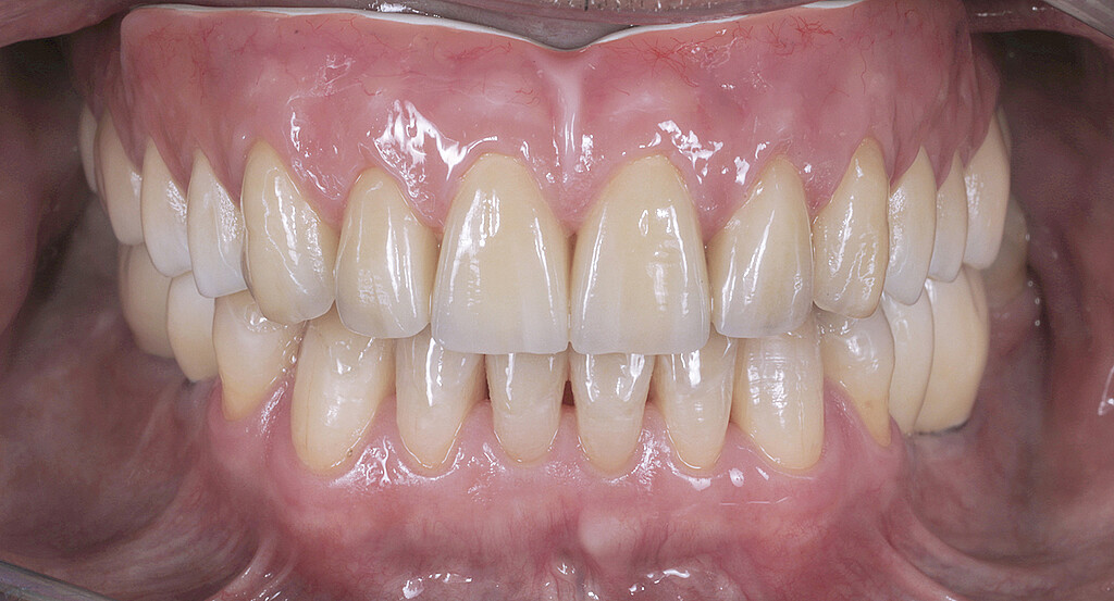 Clinical case with Pekkton® ivory. 