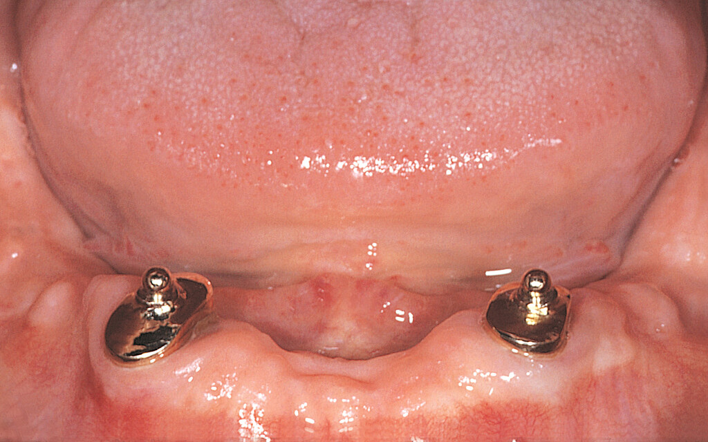 Clinical case with Dalbo®