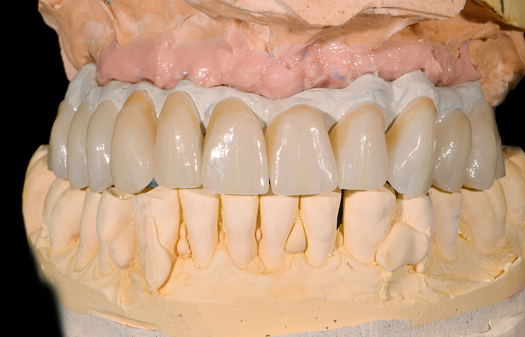 Clinical case with Pekkton® ivory. 