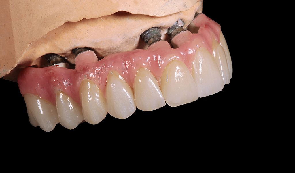 Clinical case with Pekkton® ivory. 